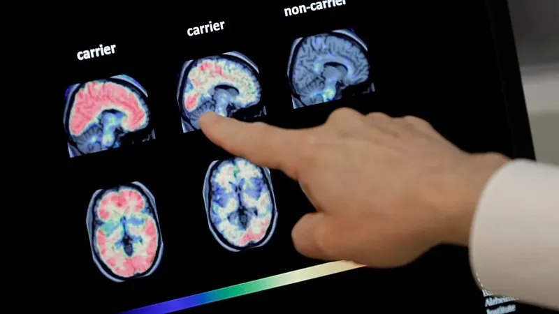 El vínculo entre el cáncer y el Alzheimer: el papel del sistema inmunitario