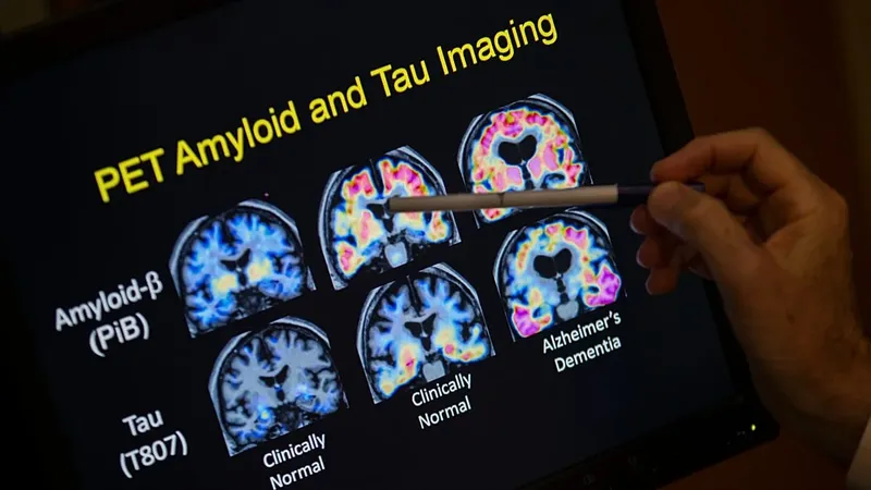 Un nuevo descubrimiento en la investigación del Alzhéimer